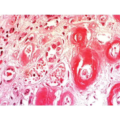 Congo Red Amyloid Stain Kit, 100mL Kit