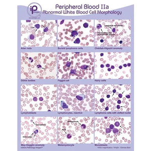 Peripheral Blood Poster • 18"W x 24"H, Abnormal White Blood Cell Morphology Peripheral Blood Poster • 18"W x 24"H, Abnormal White Blood Cell Morphology