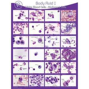 Body Fluid I: WBCs-Malignant Cells Poster