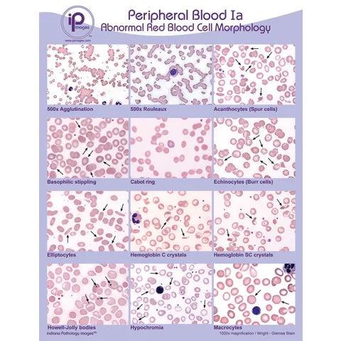 Peripheral Blood Poster • 18"W x 24"H, Abnormal Red Blood Cell Morphology