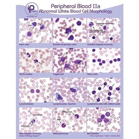 Peripheral Blood Poster • 18"W x 24"H, Abnormal White Blood Cell Morphology